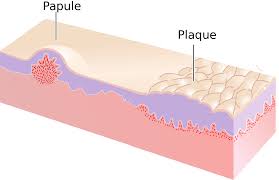 papule
