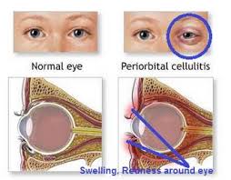periorbital