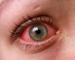 pink-eye