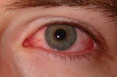 pinkeye