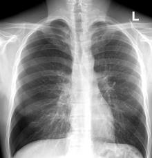 pneumothorax