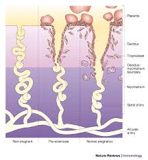 pre-eclampsia