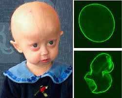 progeria
