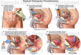 prostatectomy