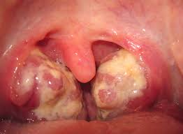 pus