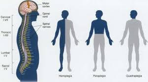 quadriplegia