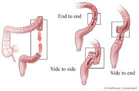 resection
