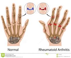 rheumatoid