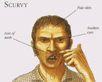 scurvy