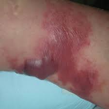 septicemia