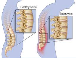 spondylitis
