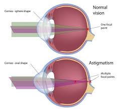 stigmatism