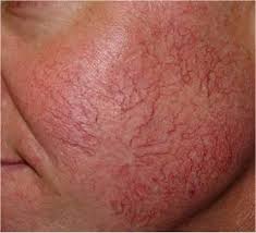 telangiectasia