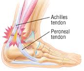 tendonitis