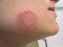 tinea