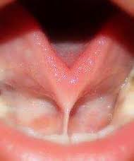 tongue-tied
