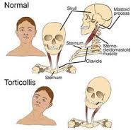 torticollis
