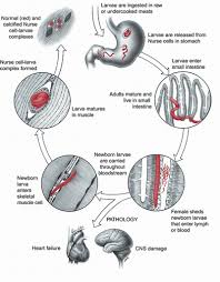 trichinosis