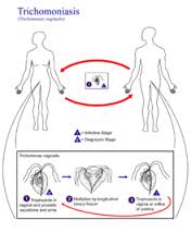 trichomoniasis