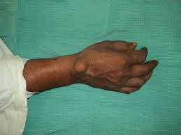 tubercular