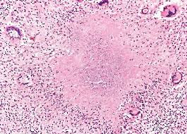 tuberculous