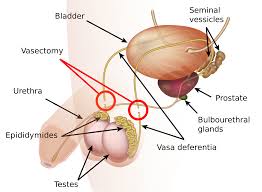 vasectomy