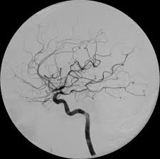 vasospasm